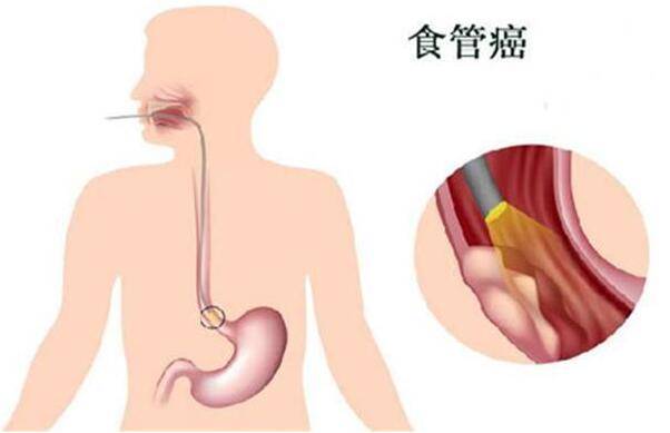 中医治疗食道鳞癌案例:2个月从插胃管维持生命到正常饮食。